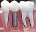 dental-implants