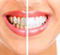 whitening